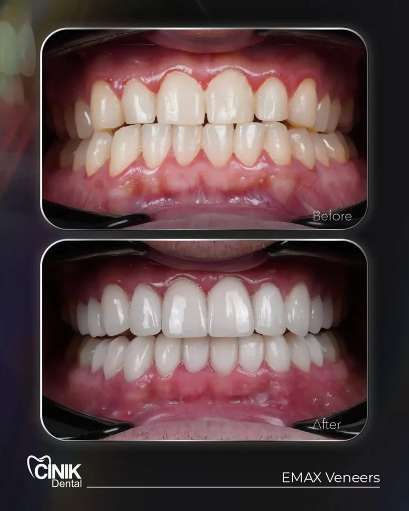 Emax veneers before after results at Dr cinik hospital