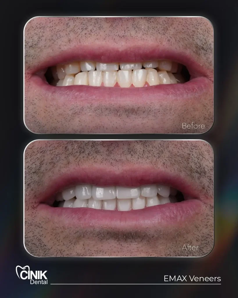 before after results for emax veneers dental treatment at dr cinik dental