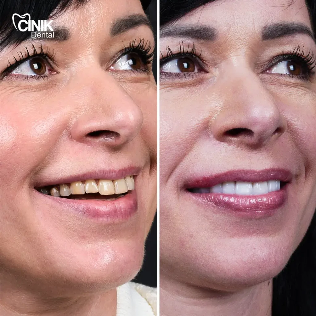 Emax veneers for heavily discolored teeth 