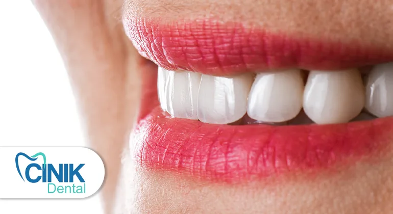Emax veneers in Turkey