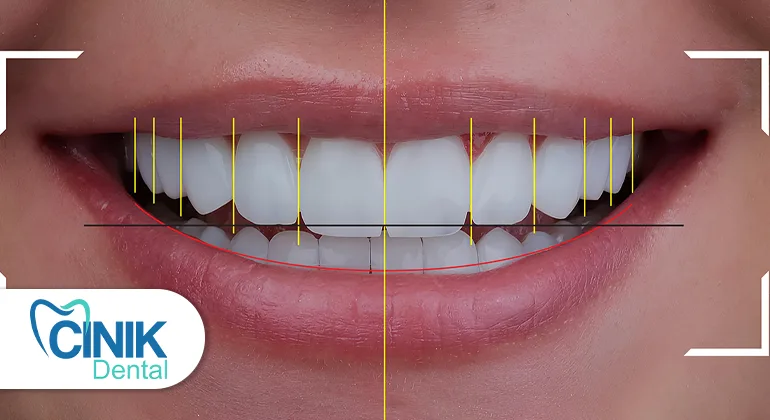 Laminate veneers customization