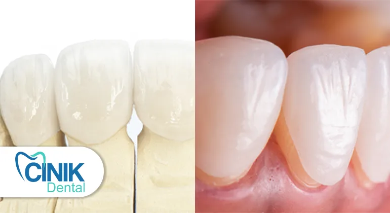 zirconia vs. porcelain in dental materials