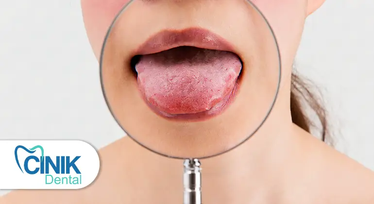 healthy tongue color