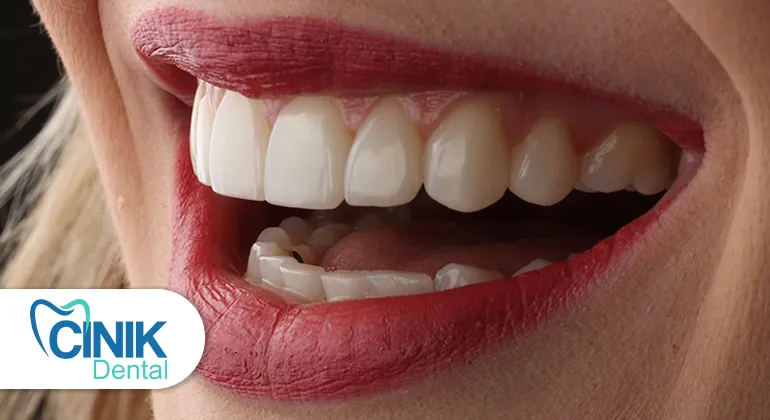 composite veneers in Turkey