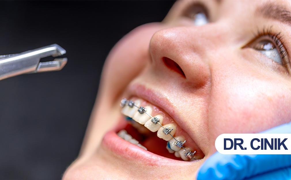 Orthodontic-treatment-braces