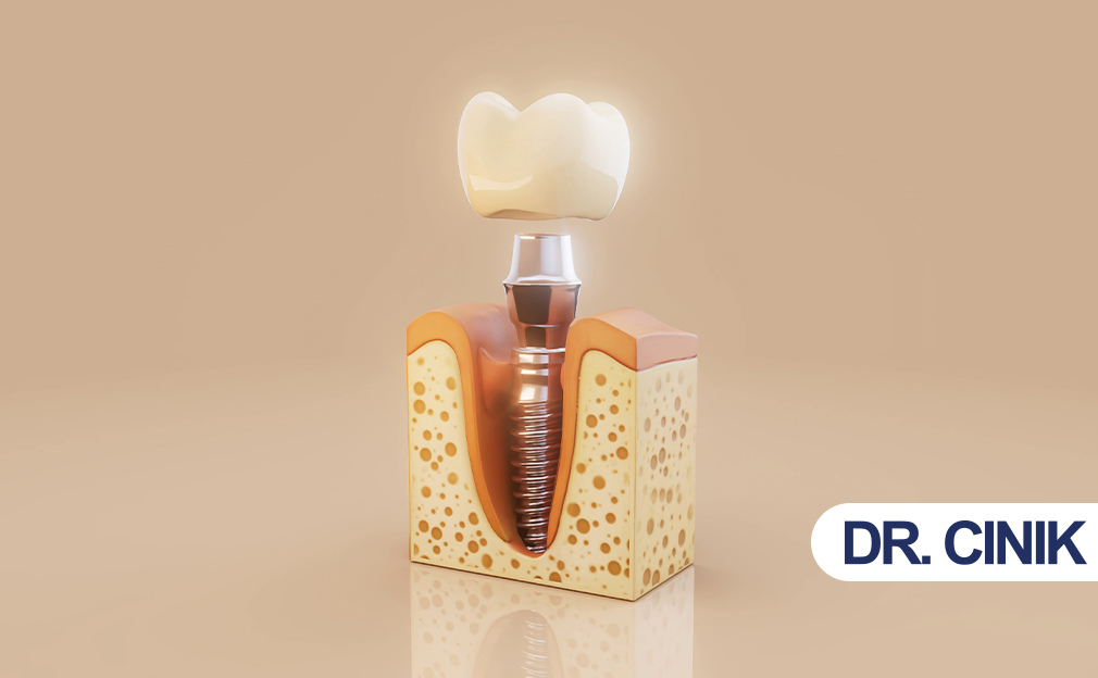 dental-implant