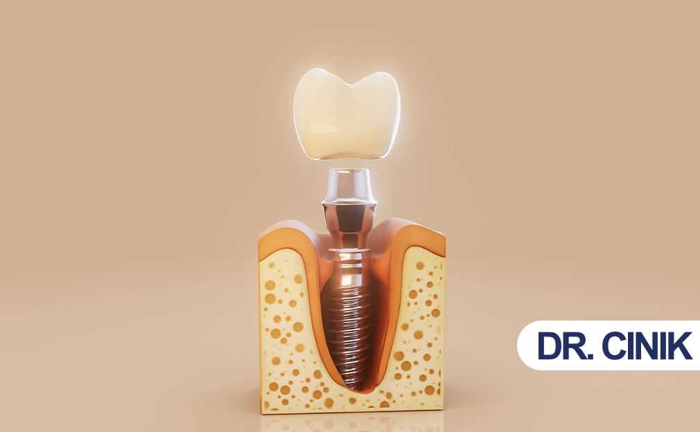 dental implant